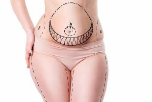 Tummy Tuck Turkey result Dr. Hakkı Izmirli