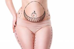 abdominoplastie avant après – Dr. Hakkı Izmirli