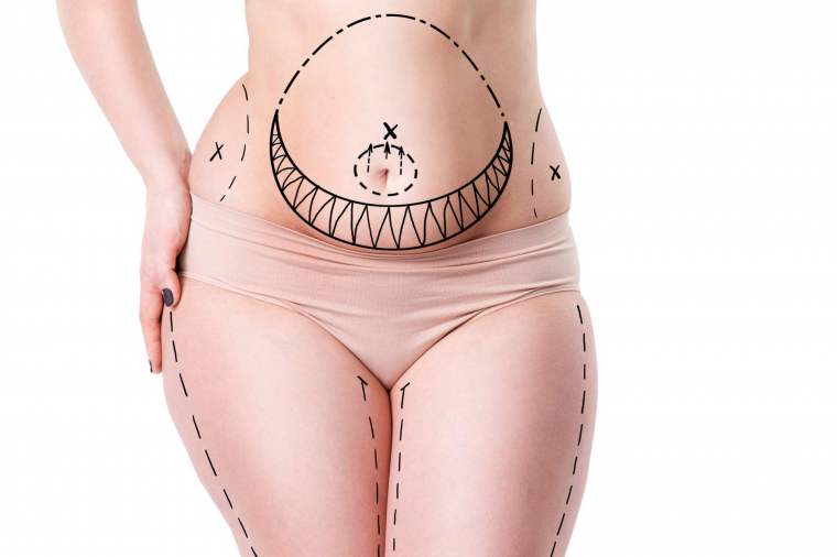 abdominoplastie avant après – Dr. Hakkı Izmirli