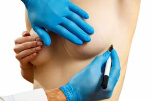 Breast reduction surgery in Istanbul by Dr. Hakkı İzmirli